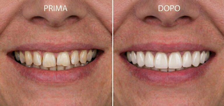 Confronto fotografico prima e dopo di un trattamento di estetica dentale. A sinistra denti naturali ingialliti e disallineati (Prima), a destra un sorriso bianco, dritto e perfetto dopo l'applicazione di faccette o corone estetiche (Dopo)