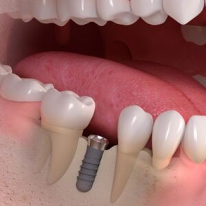 Impianto dentale singolo in titanio e corona in ceramica - Monti Dental Center Poggibonsi